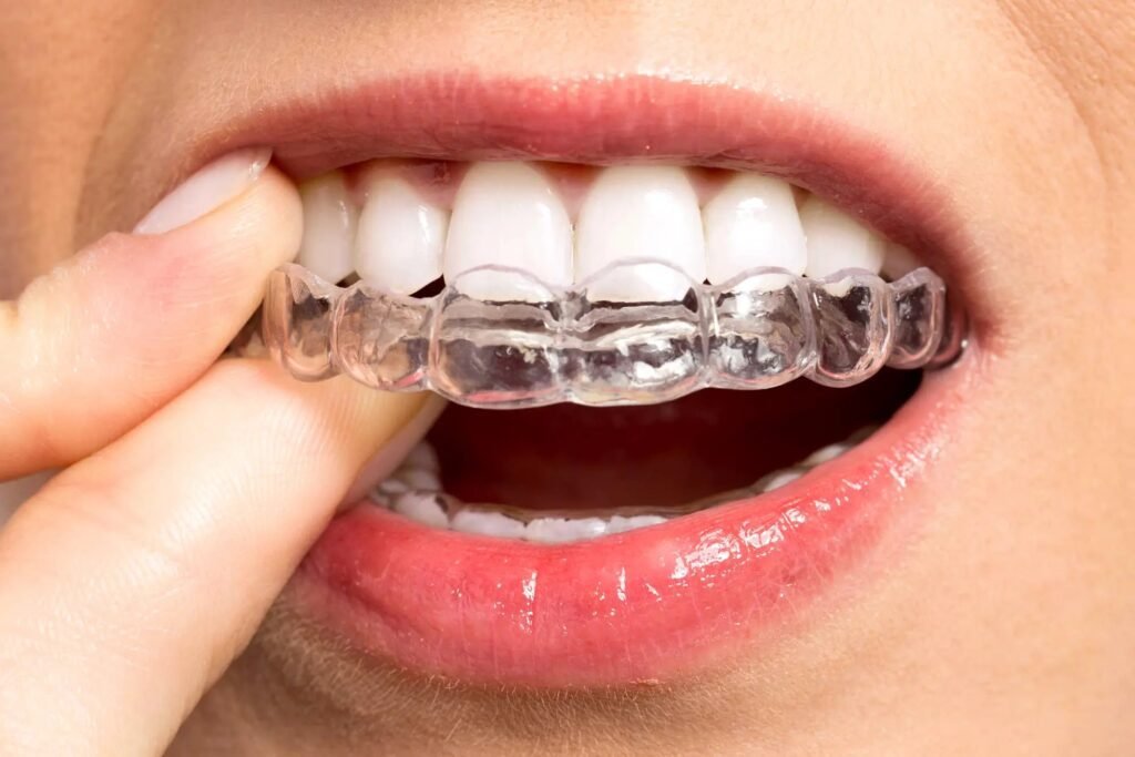 Clear Aligners