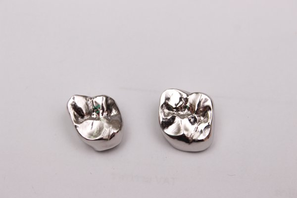 Full-metal crown — maximum strength and minimal tooth reduction for posterior teeth