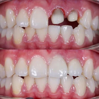 Single zirconia crown — precision-milled for a perfect fit and natural translucency