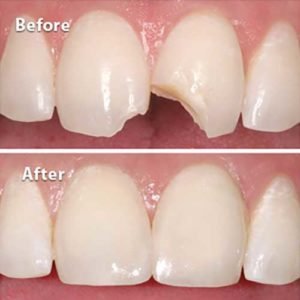 Fractured tooth restored with composite — seamless repair matching natural tooth shade