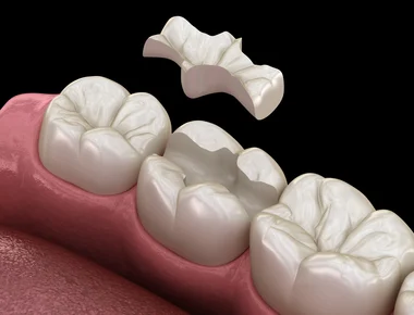 Ceramic inlay — lab-fabricated solid porcelain piece seated inside the prepared tooth cavity