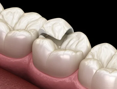 Ceramic onlay — extends over one or more cusps for larger cavities needing more coverage than an inlay