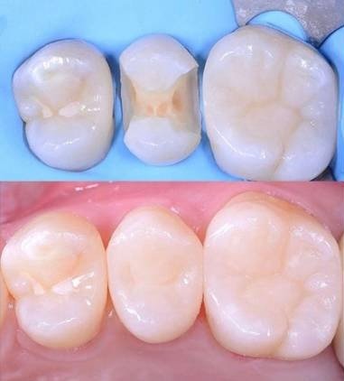 Composite restoration on posterior tooth — perfectly blended with surrounding natural enamel