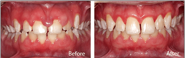 Gum Treatment