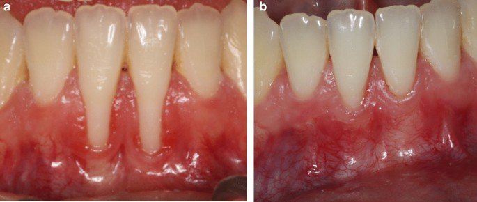 Gum recession coverage — before and after results