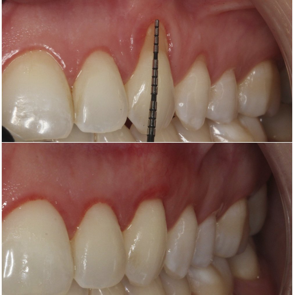 Gum recession coverage — restoring receded gum tissue