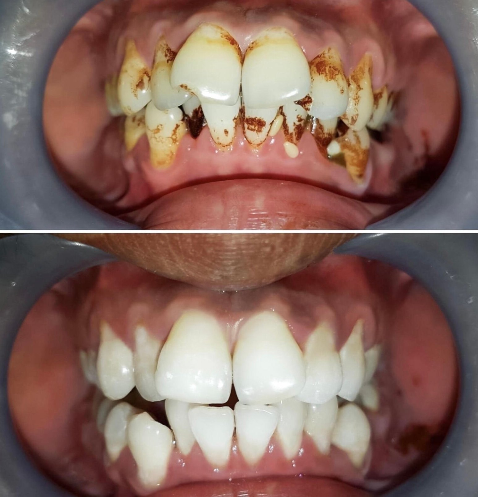 Scaling and stain removal — before and after comparison