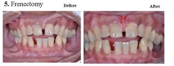 Frenectomy with laser — tongue-tie release without cuts or stitches