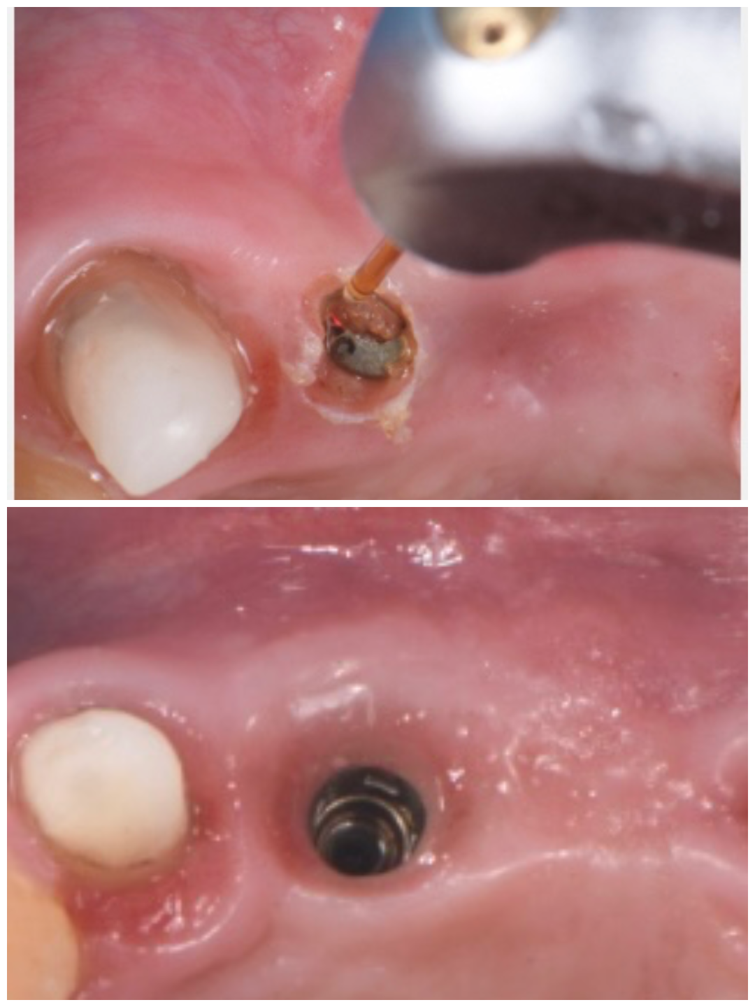 Laser implant exposure — healing abutment placement without scalpel