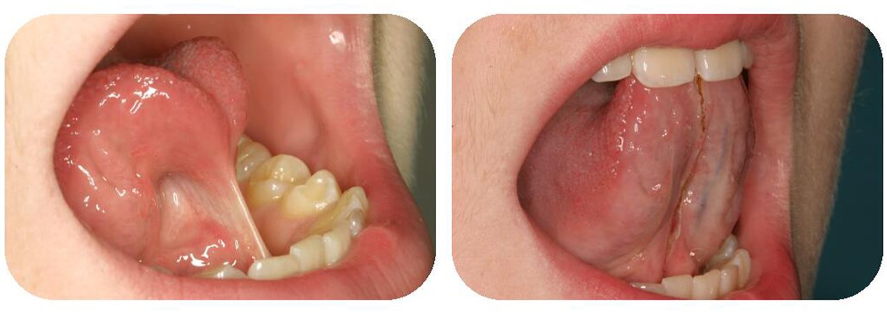 Laser tongue-tie removal — painless release for improved speech