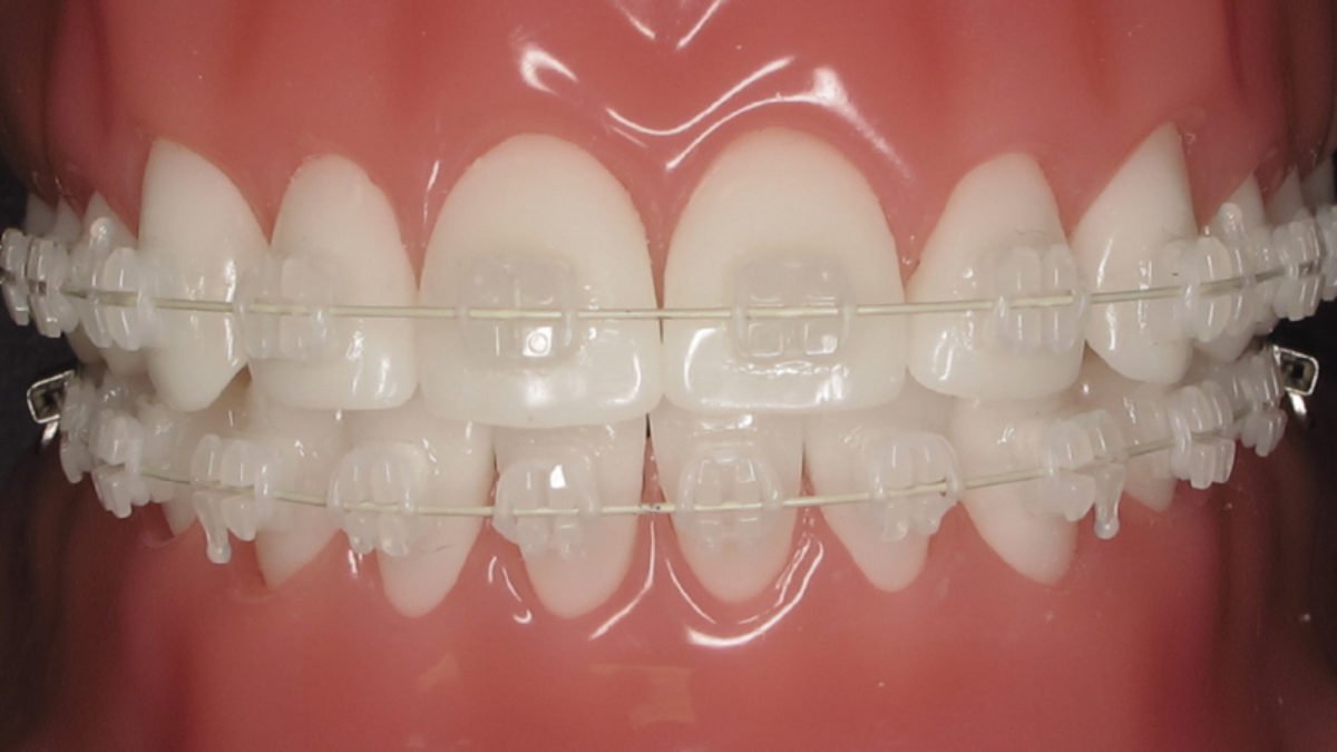 Ceramic tooth-coloured braces — a discreet aesthetic option