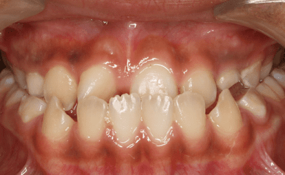 Crossbite — upper and lower teeth misaligned laterally