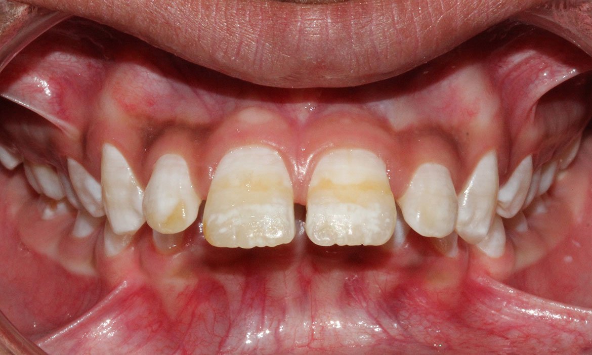 Severely protruded teeth with deep bite