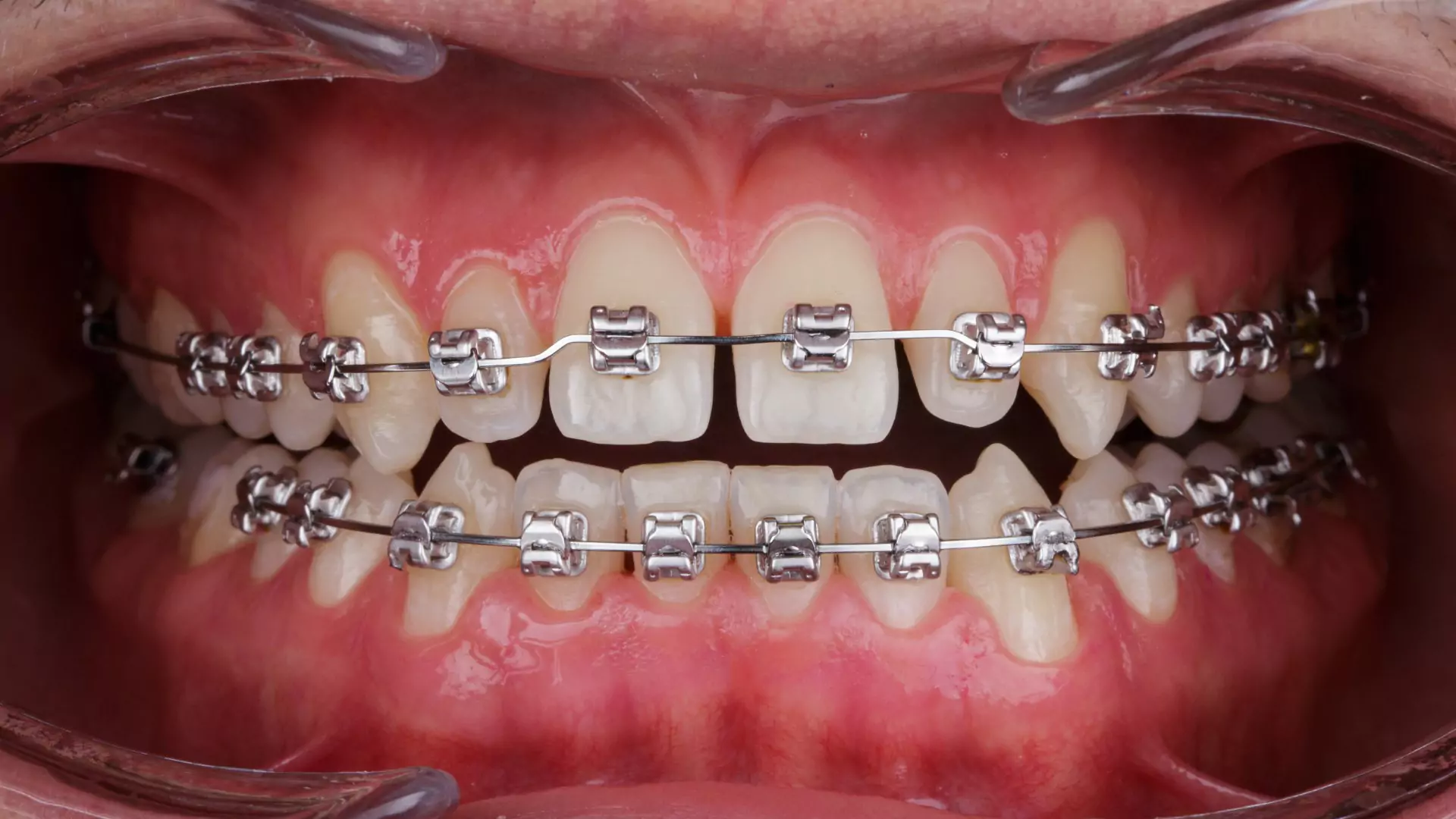 Self-ligating metal braces — faster treatment, fewer visits