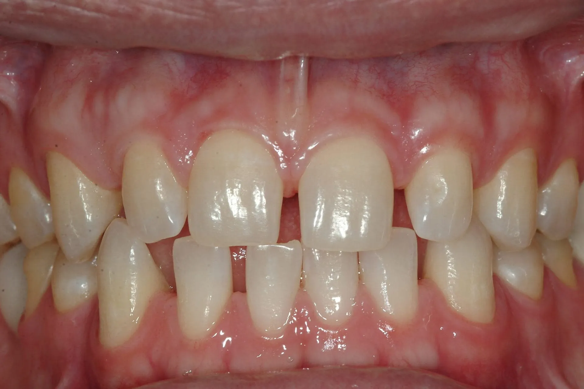 Spaced teeth — gaps between teeth