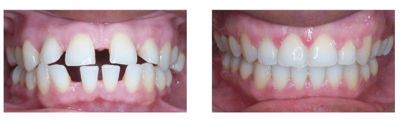 Before & after — spacing and proclination
