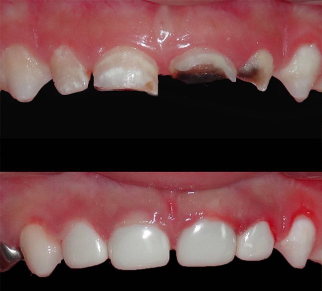 Polycarbonate crown placed after pulpectomy — restoring a milk tooth