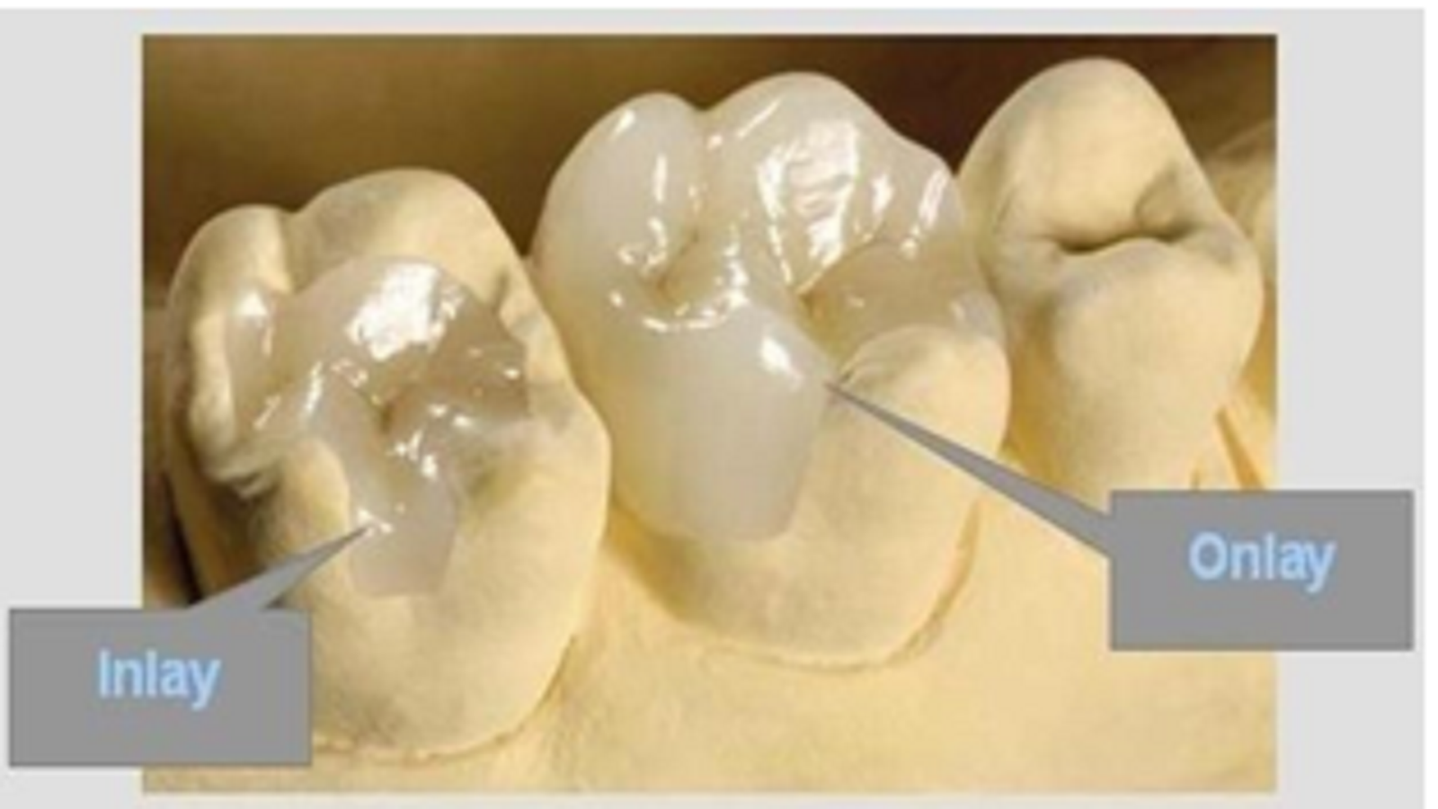 Ceramic Inlays & Onlays