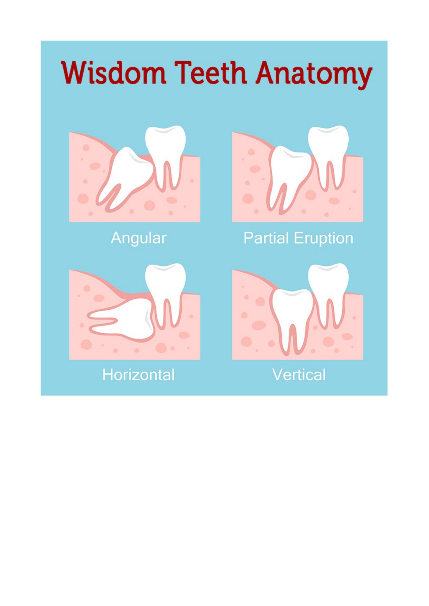 Common situations requiring wisdom tooth removal — impaction types & indications