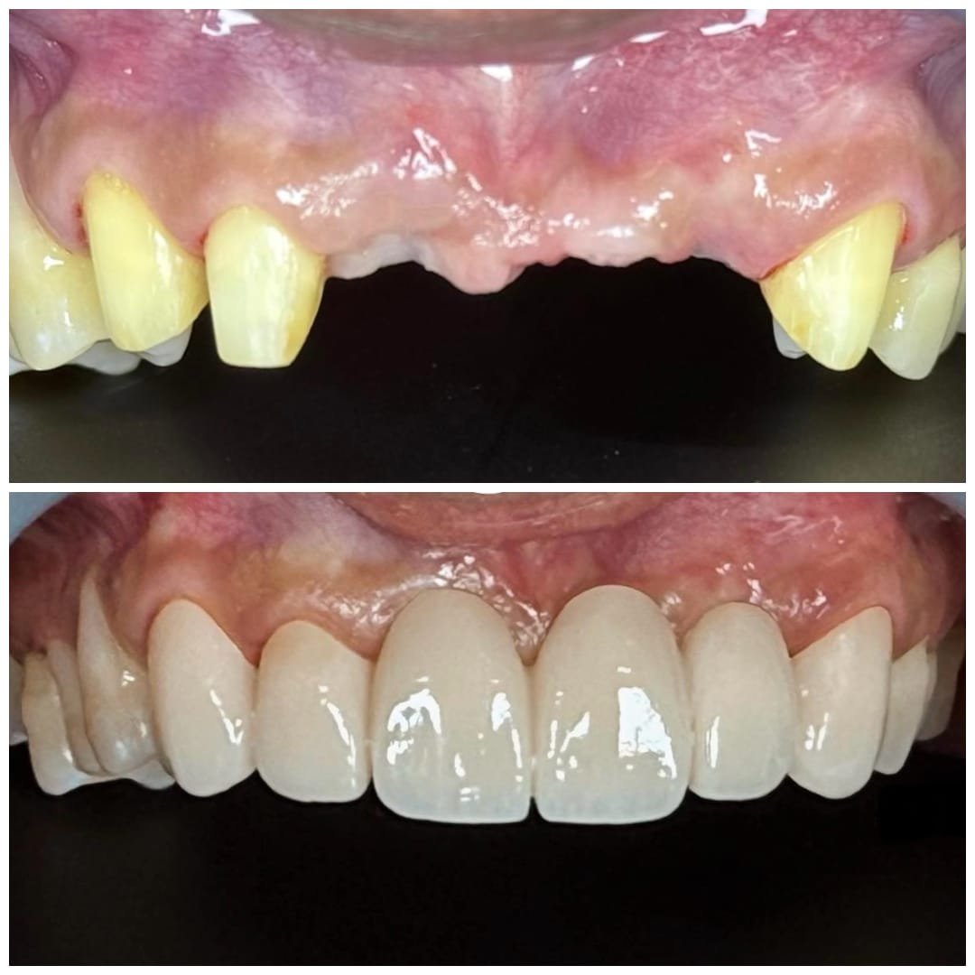 Before & after: damaged front teeth rebuilt with full-ceramic crowns for a seamless, natural-looking smile