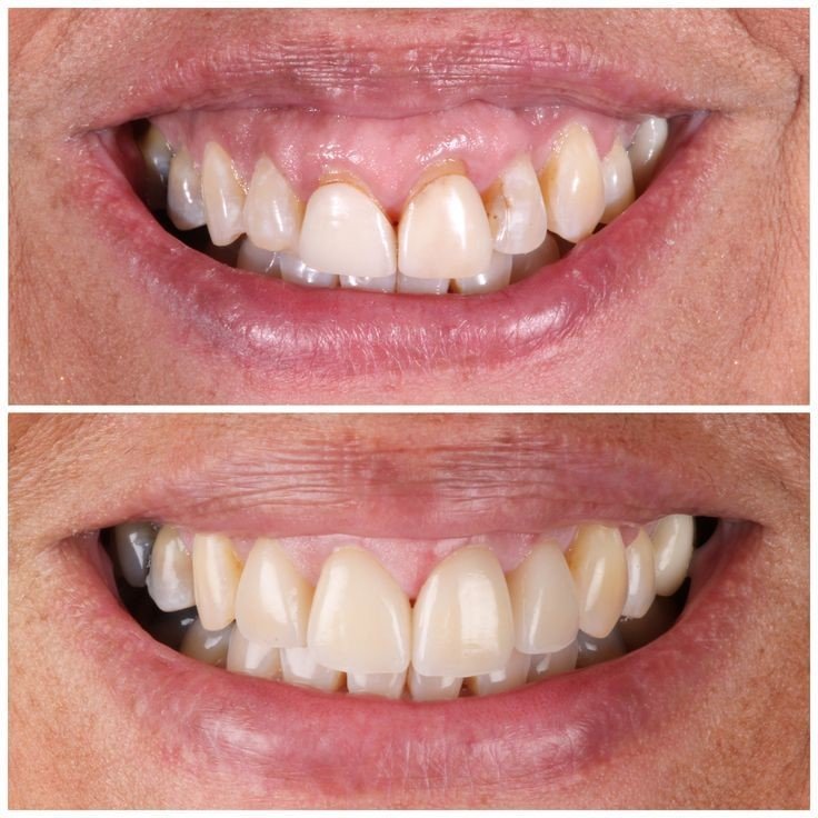 Before & after: gummy smile with worn, discoloured teeth rebuilt with ceramic crowns and improved gum proportions