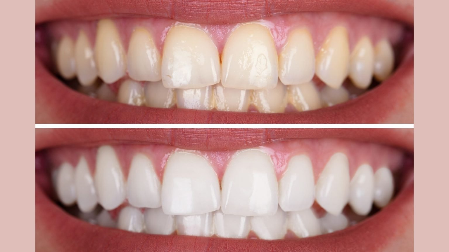 Before & after: dramatic shade improvement after a single professional whitening session