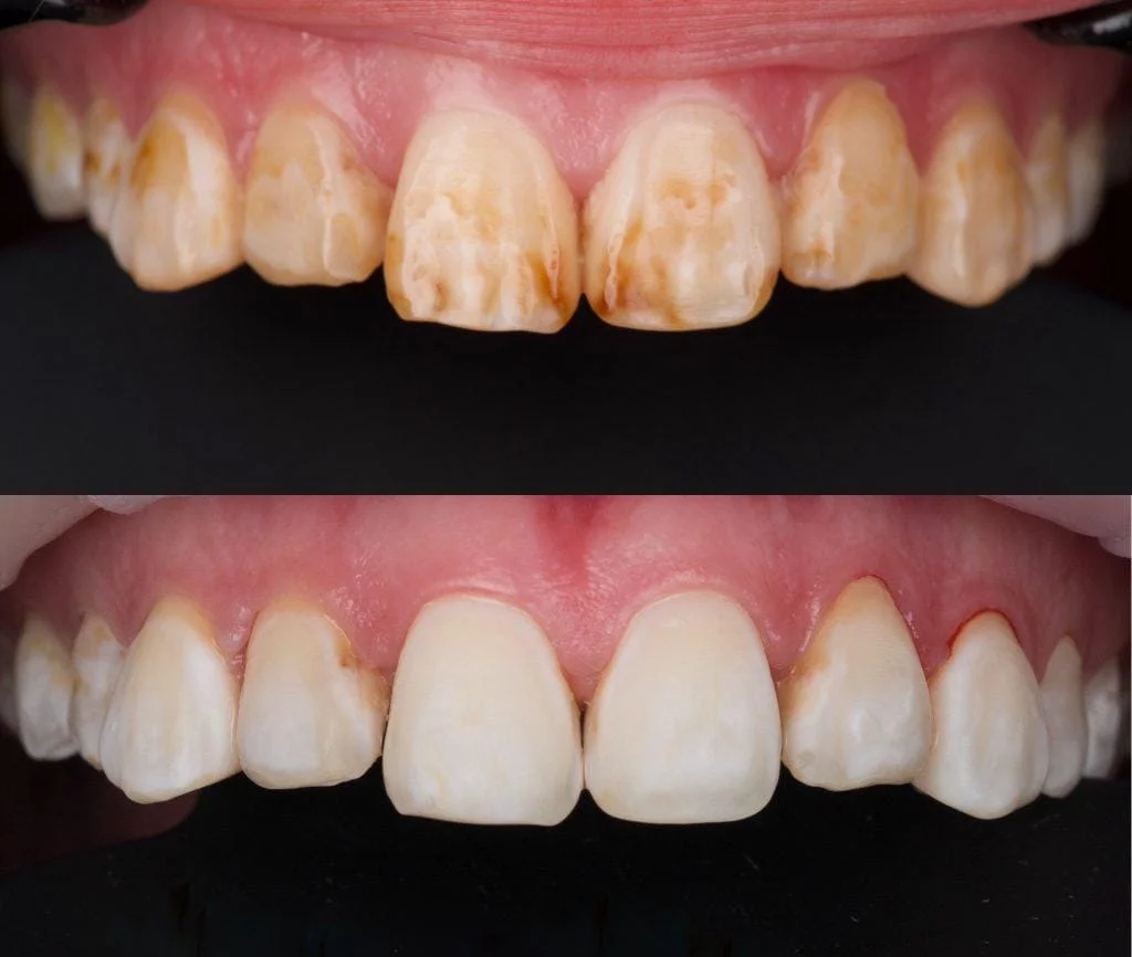 Dental fluorosis treated with bleaching — stains safely removed for a uniform, bright smile