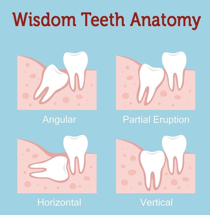 Wisdom teeth anatomy — angular, partial eruption, horizontal & vertical impactions